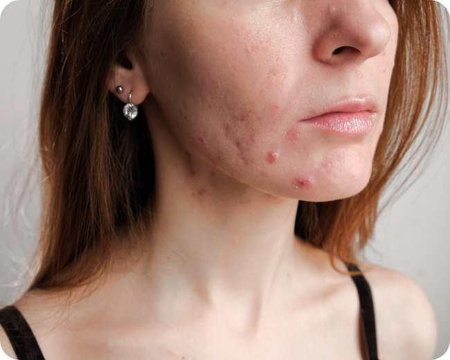 Adult Acne is Real: A Skincare Routine That Actually Works