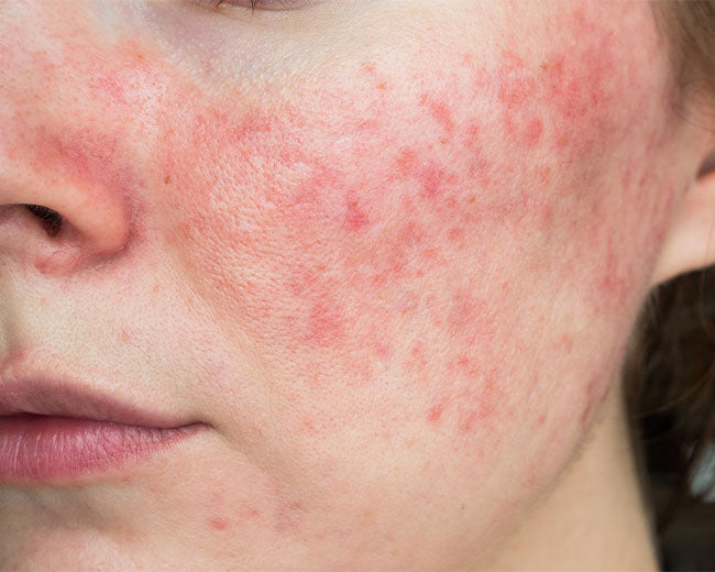 Rosacea Skin Care