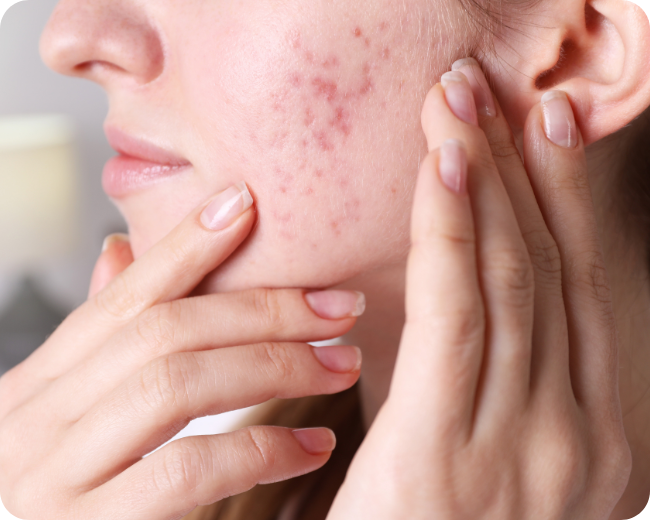 Summer Acne Is Real – Why Your Skin Freaks Out in the Heat (And What to Do About It)