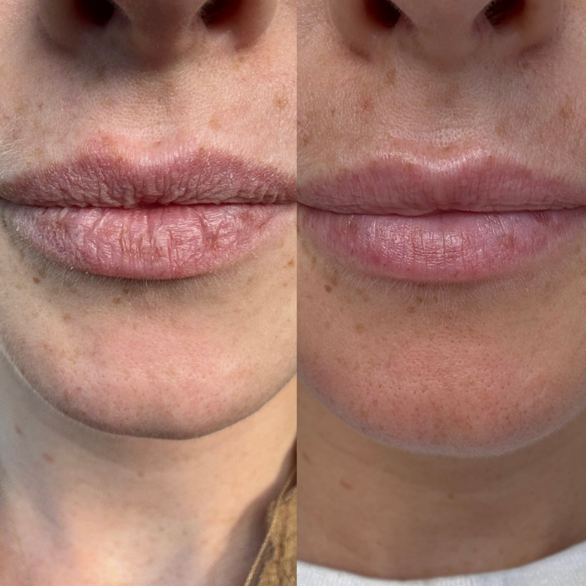 Pro-Lip Balm