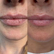 Pro-Lip Balm