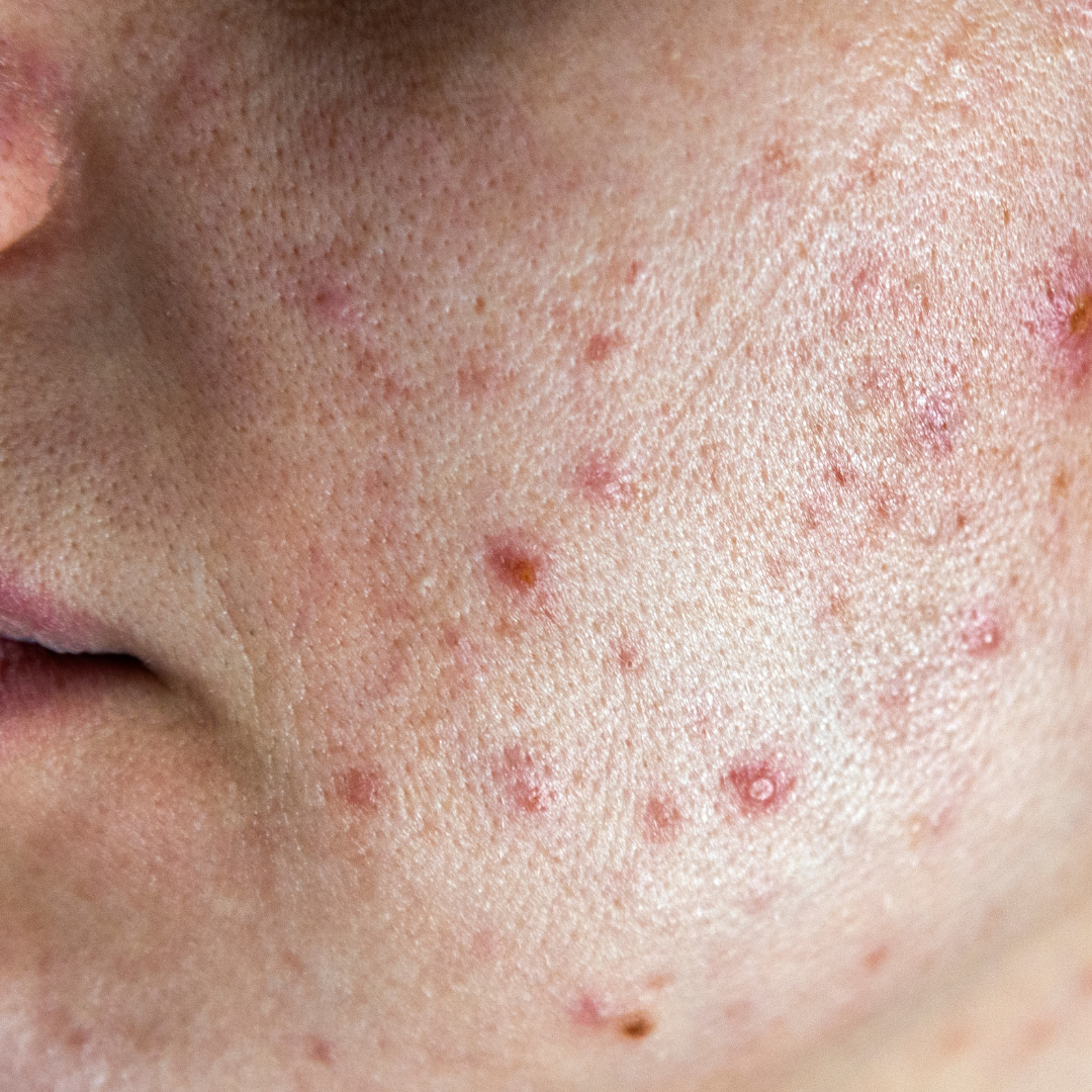 Acne.png