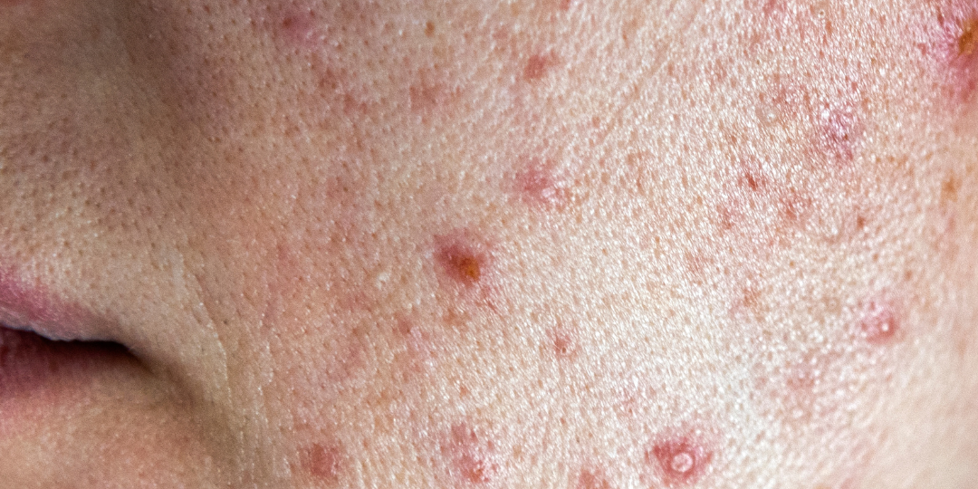 Acne.png