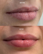 Pro-Lip Balm - Bloc Skincare - Dry lips - before and after results