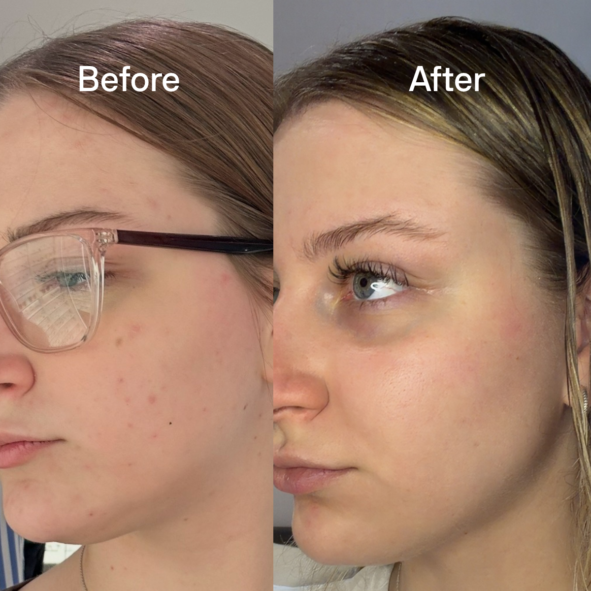 Before and After product results - Visibly more clear and even looking skin after using Bloc Antioxidant Serum