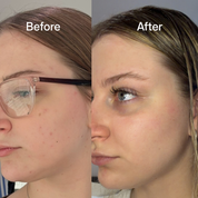 Before and After product results - Visibly more clear and even looking skin after using Bloc Antioxidant Serum