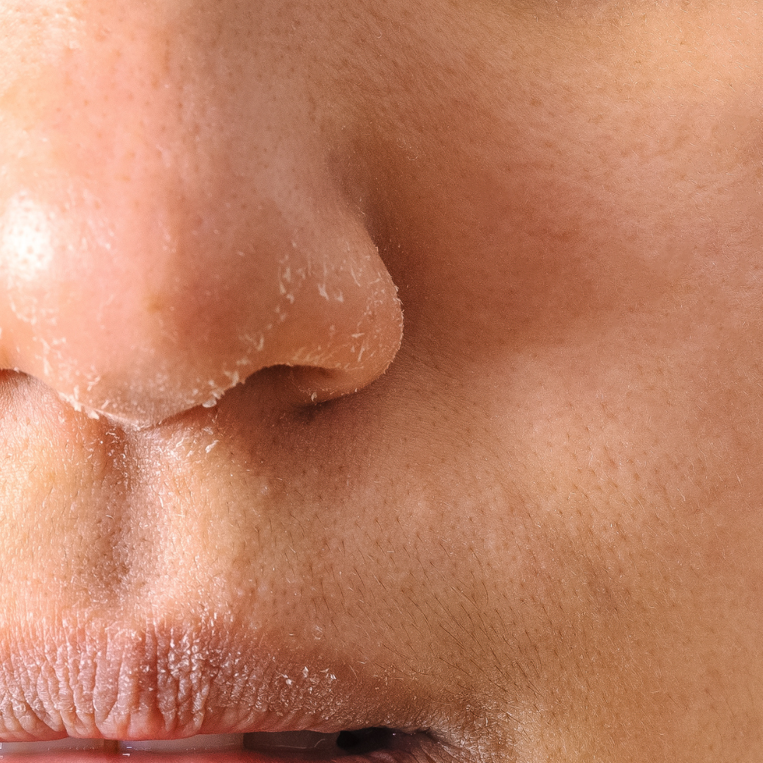 Dry_Skin.png