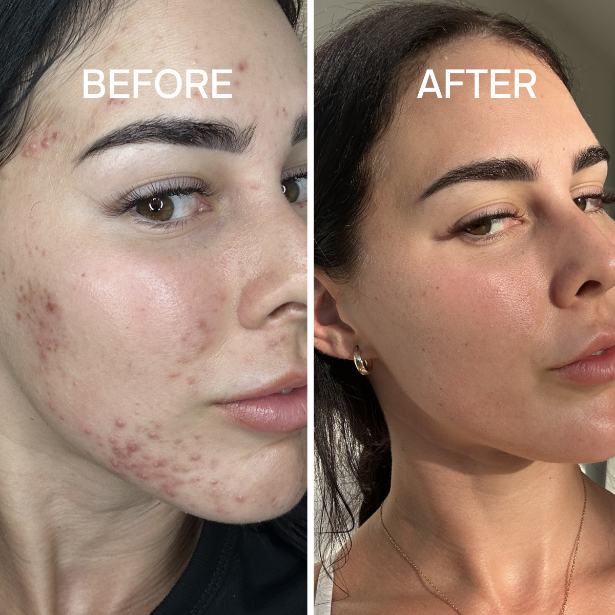 Acne Regime