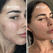 Acne Regime
