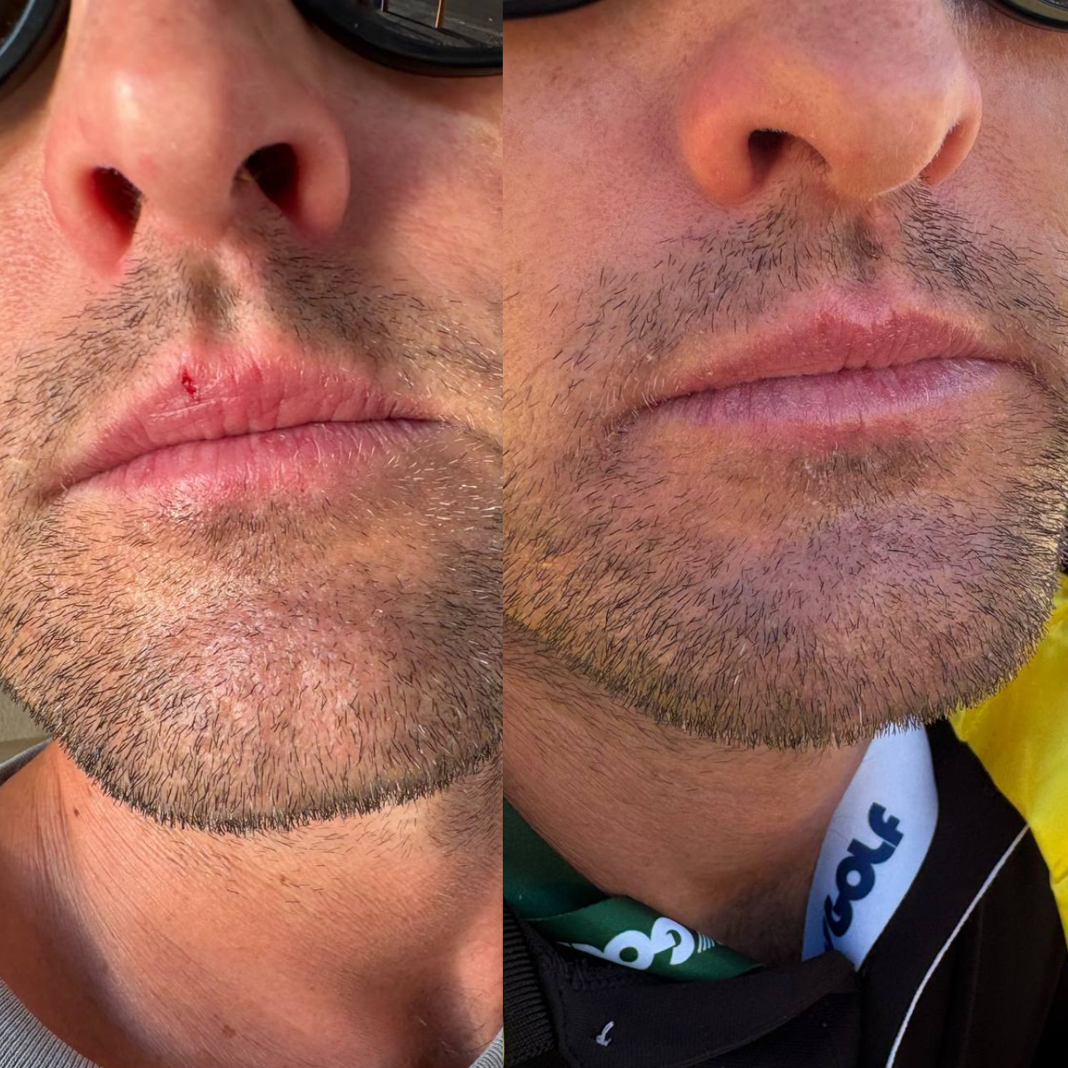 Pro-Lip Balm