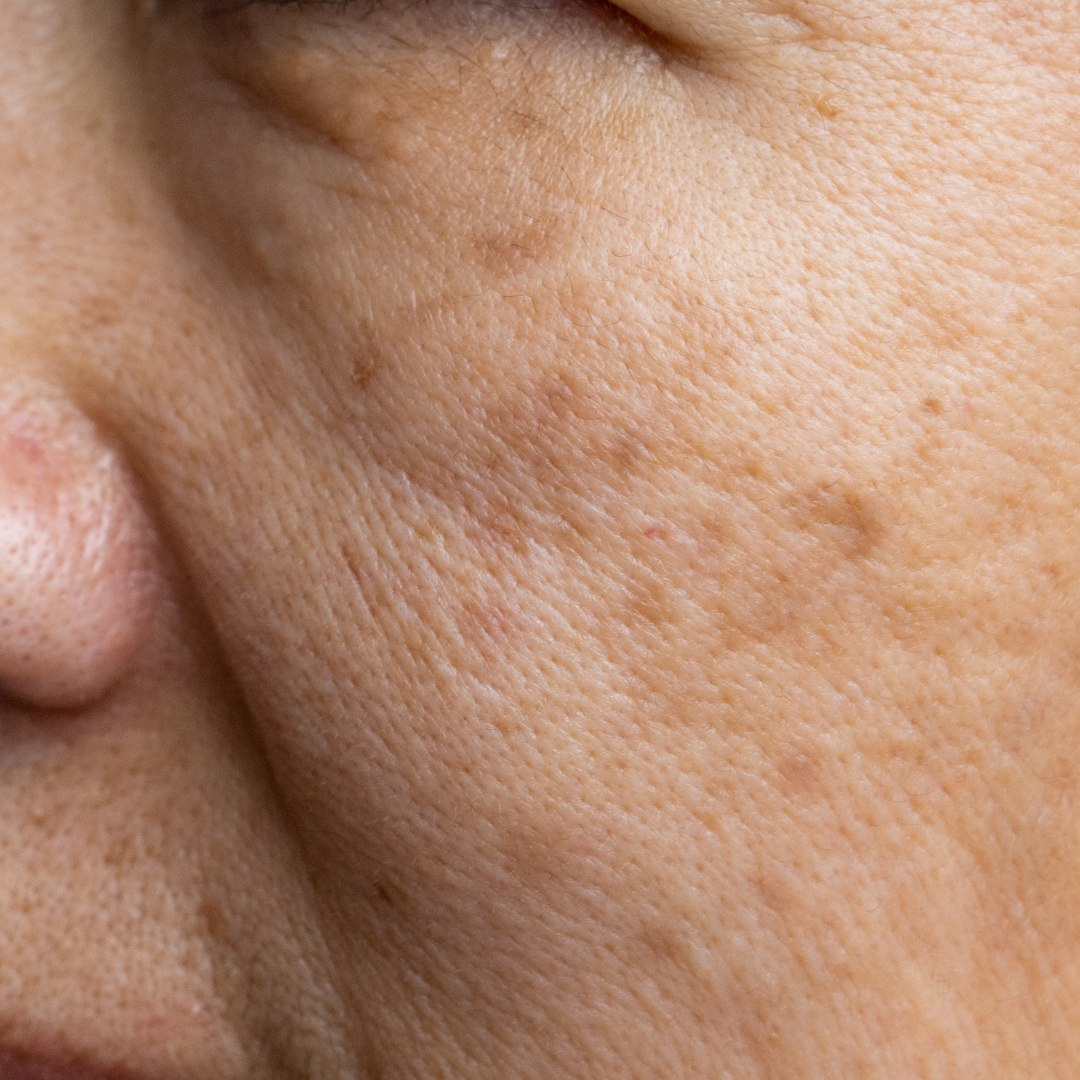 Pigmentation.png