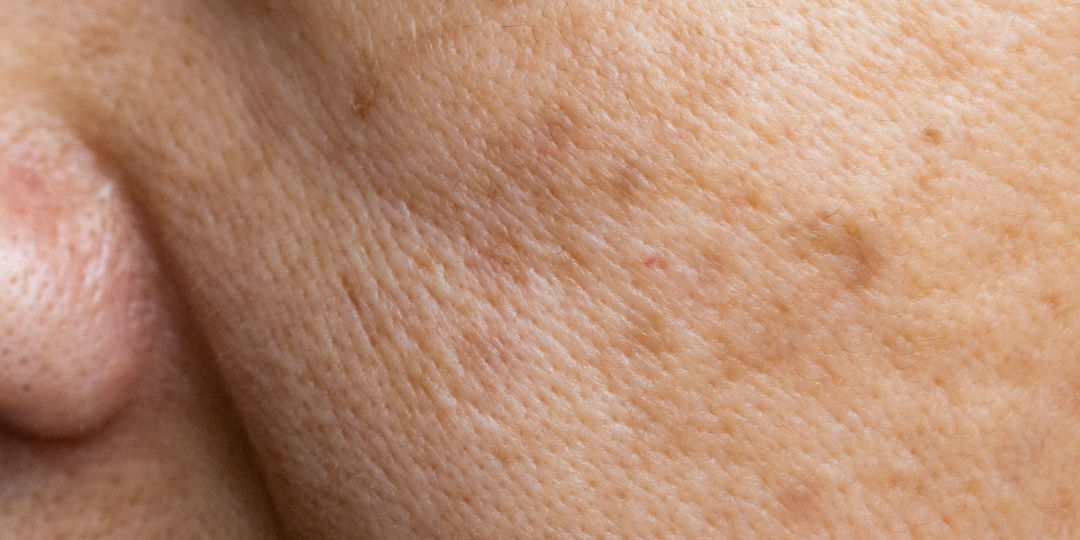 Pigmentation.png