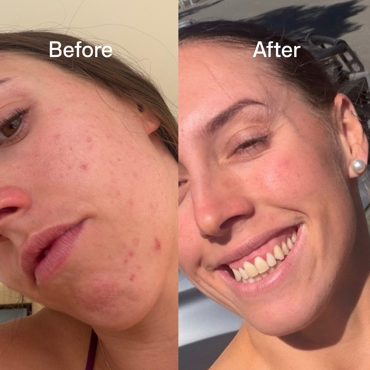 Pro-B Serum results, acne, a Dermatologist-formulated niacinamide serum