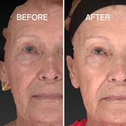 Bloc Pro-Peptide Serum with peptides, bakuchiol and vitamin C, before and after results, transformation, anti-ageing serum