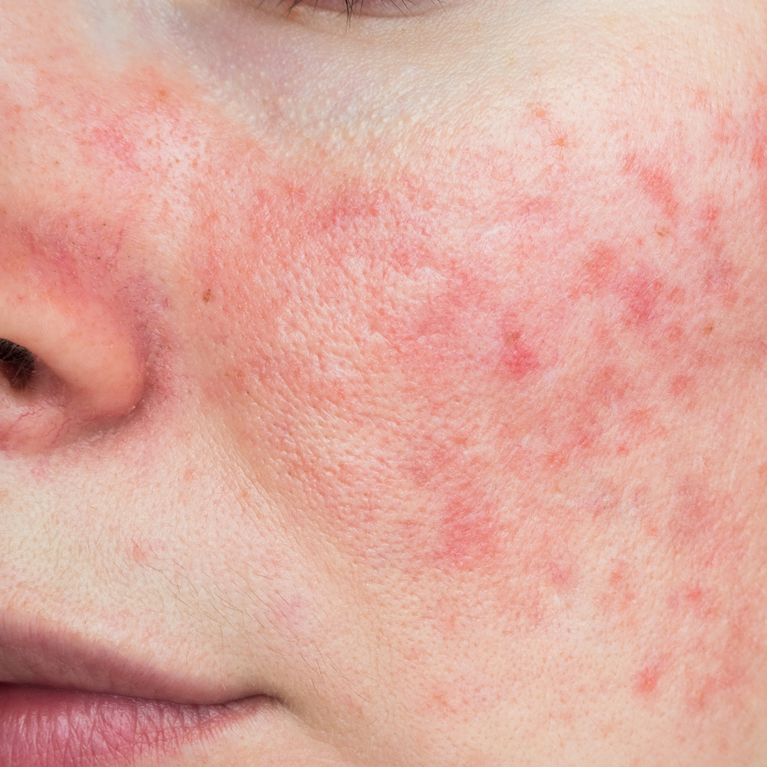Rosacea.png