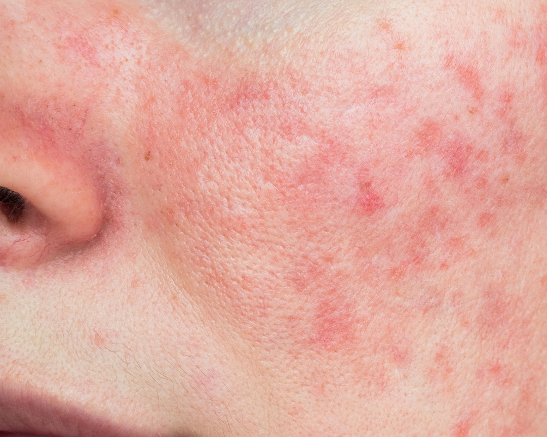 Rosacea.png