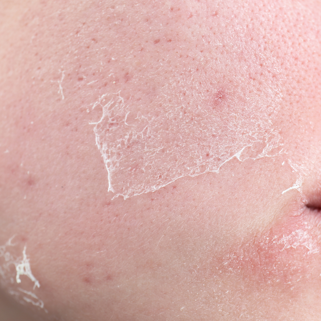 Sensitive_Skin.png