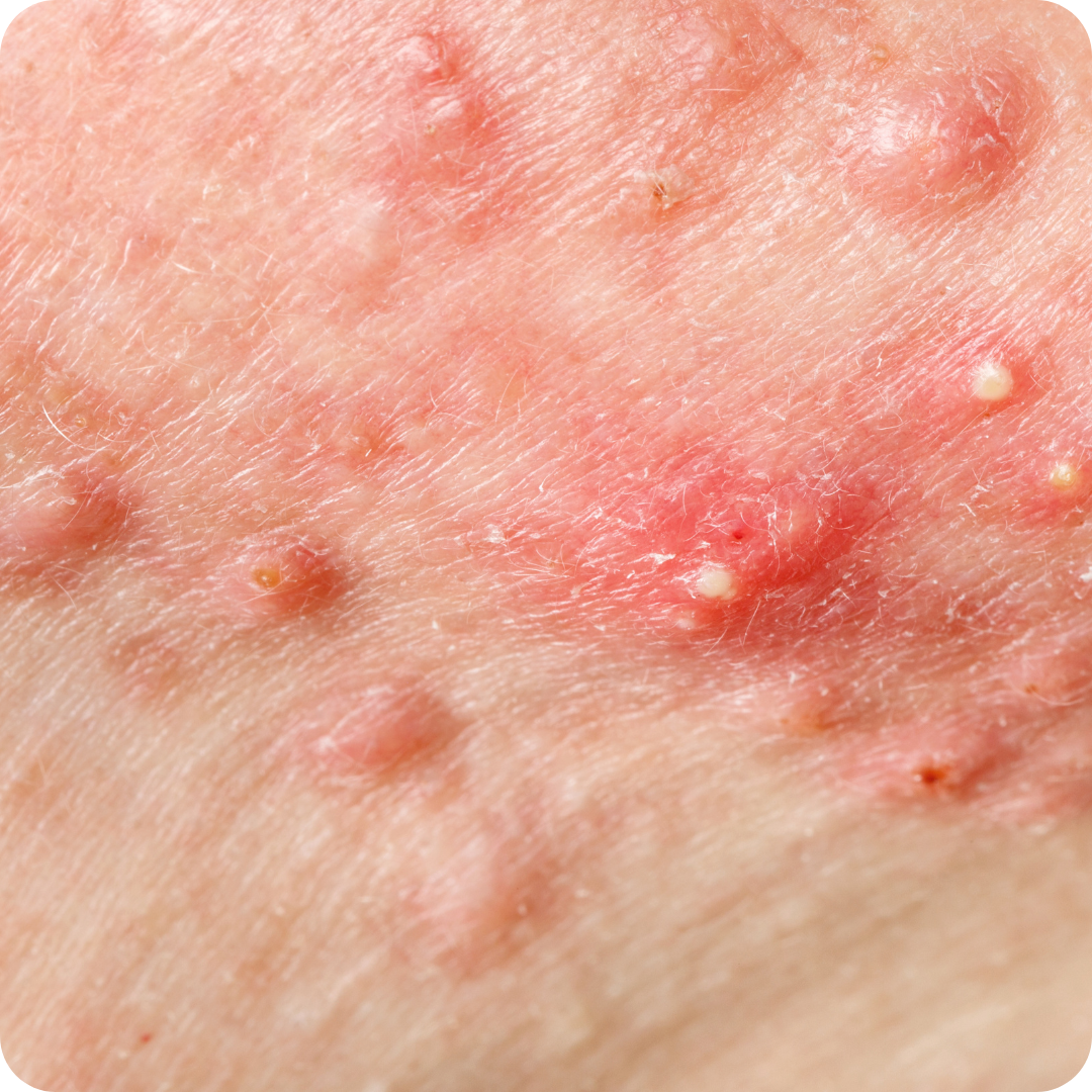 Acne-Prone Skin