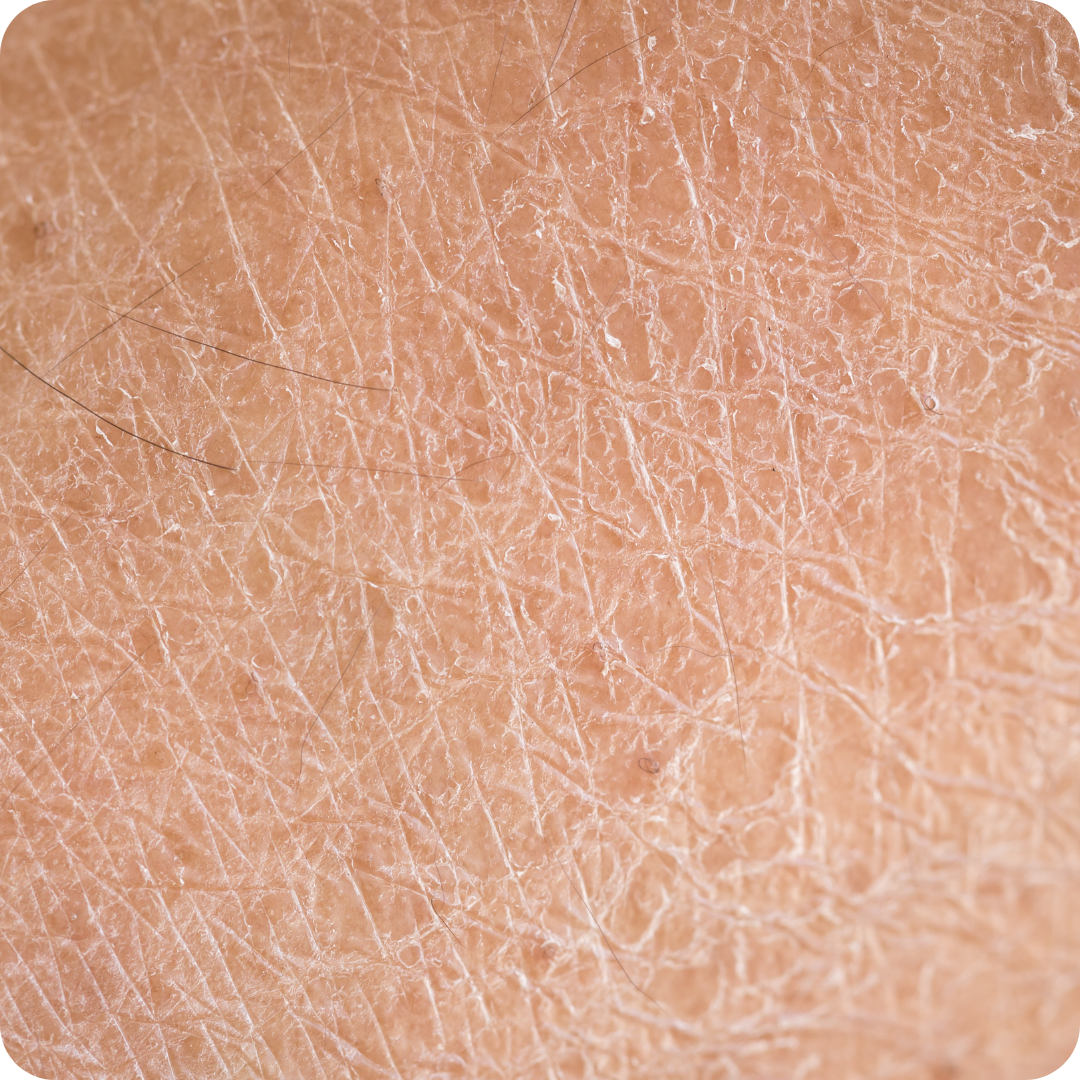 Dehydrated Skin