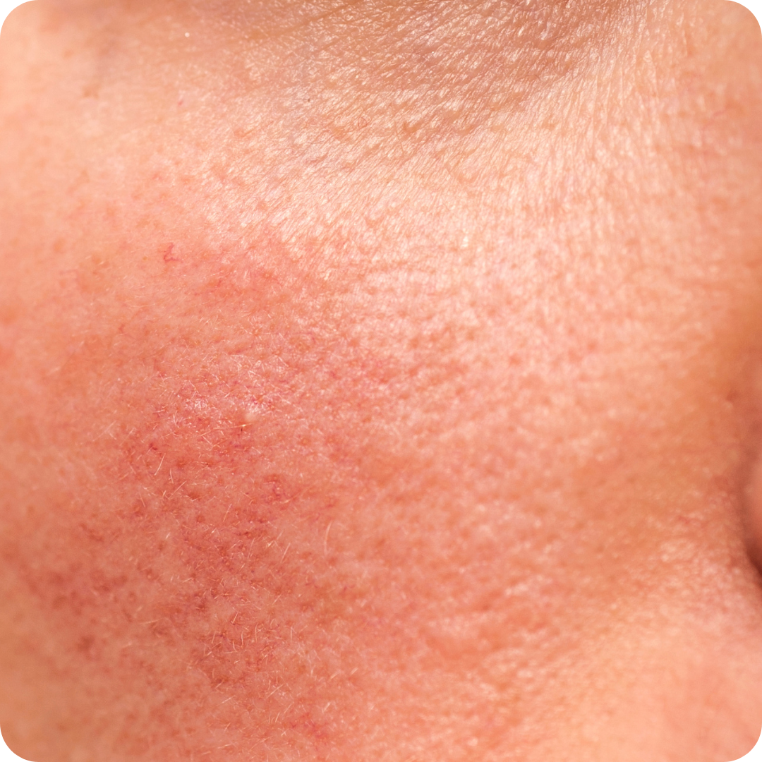 Sensitive Skin